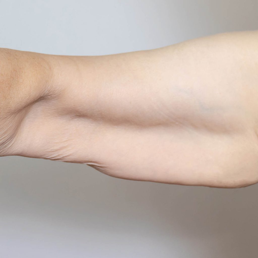Loose Skin - Illumia Medical