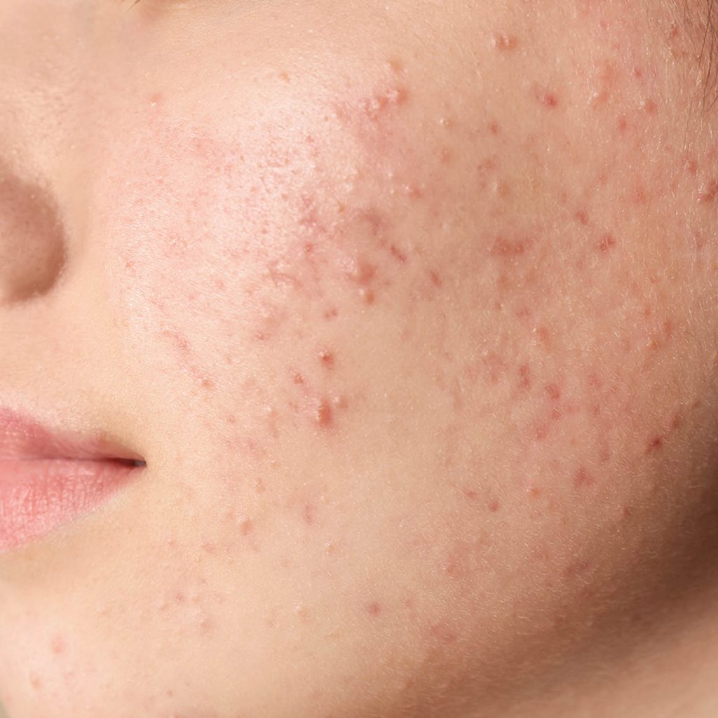 Face Acne - Skin Concerns - Illumia Medical