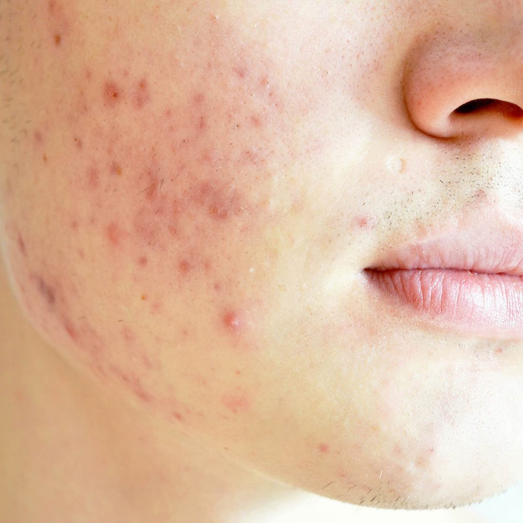 Acne on Face - Skin Concerns - Illumia Medical