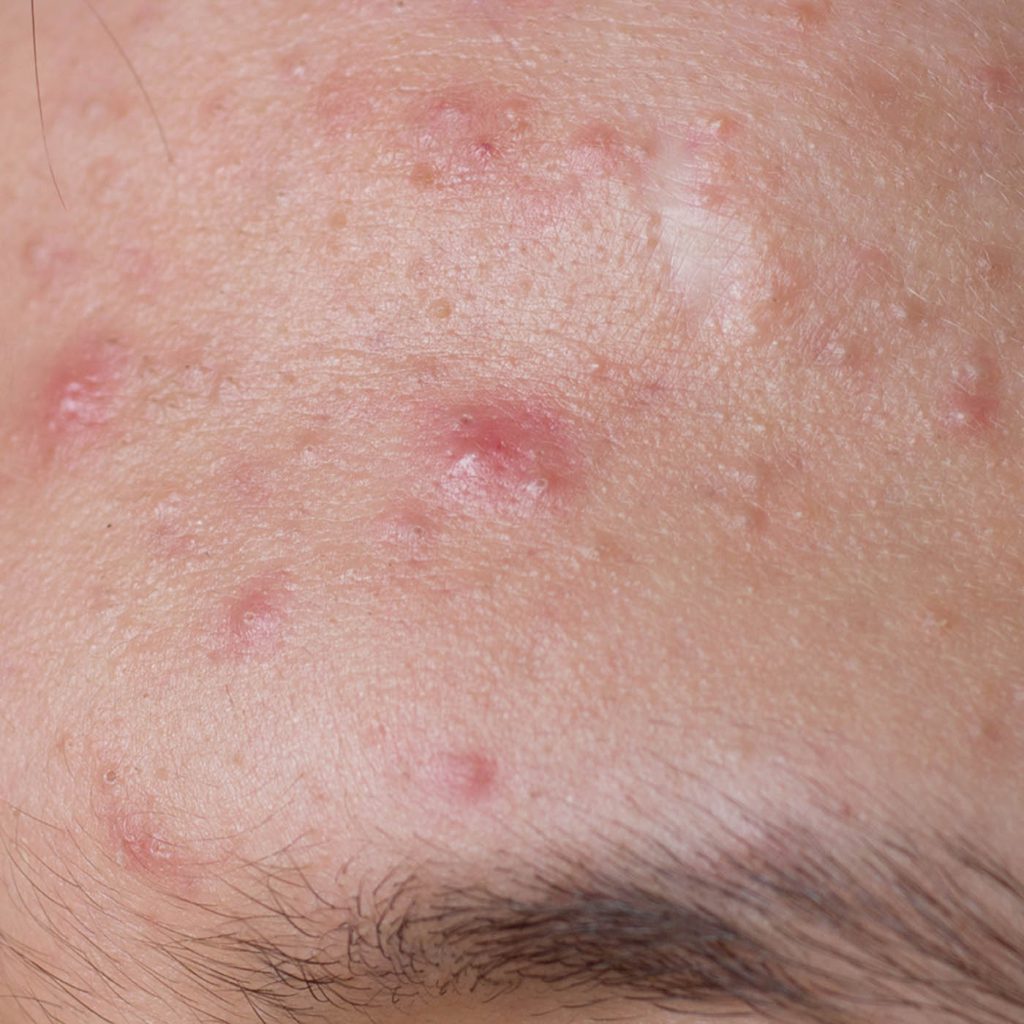 Acne - Skin Concerns - Illumia Medical