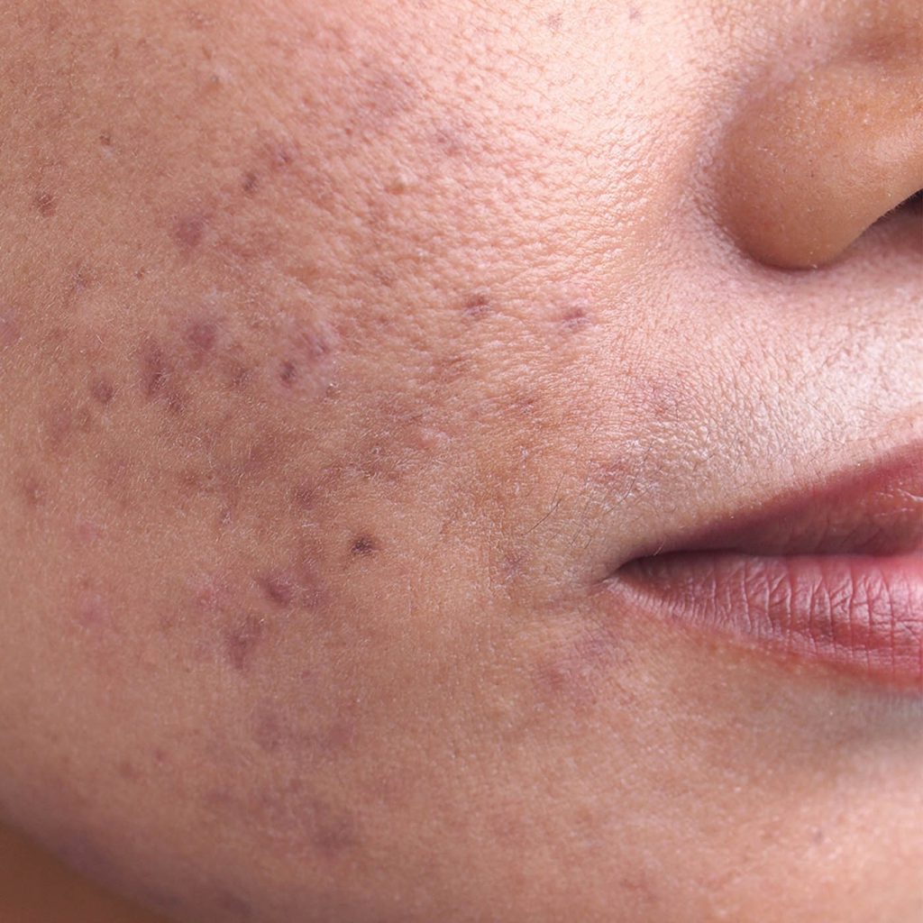 Face Acne Scars Face Acne Scars - Skin Concerns - Illumia Medical