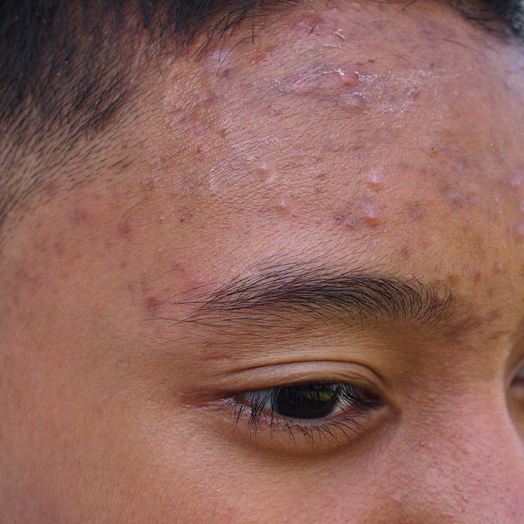 Acne Scars Acne Scars on Face - Skin Concerns - Illumia Medical