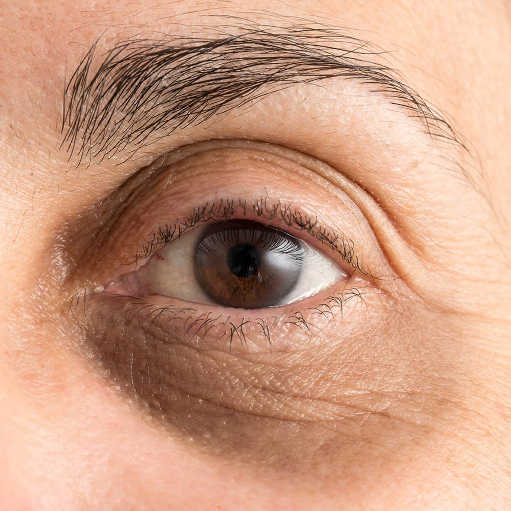 Dark Eye Circles Dark Eye Circles