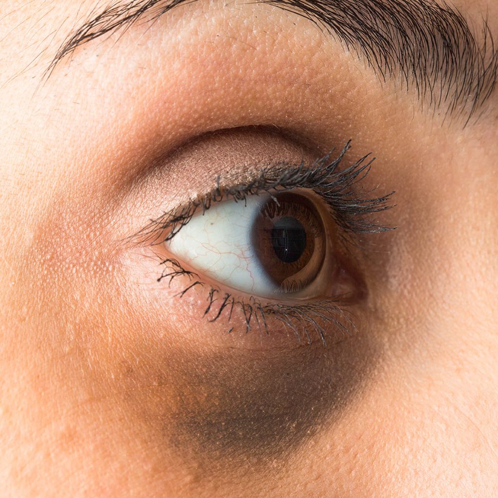 Under Eye Wrinkle Under Eye Wrinkle