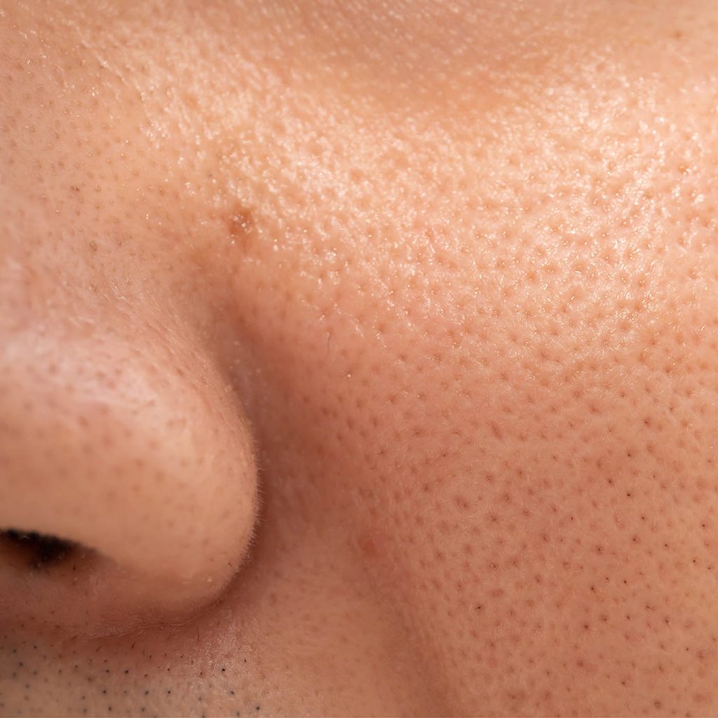 Enlarged Pores - Skin Concerns - Illumia Medical