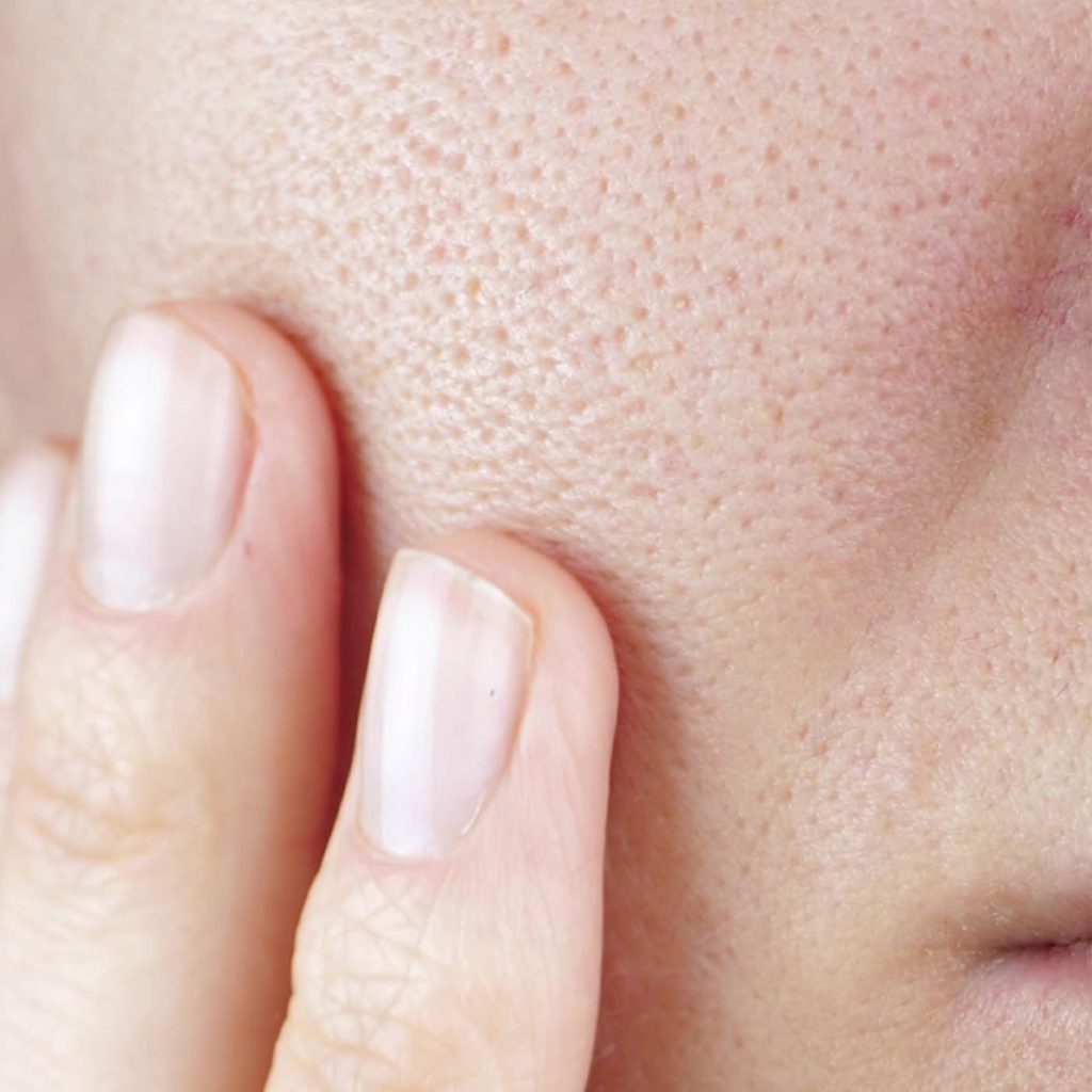 Enlarged Pores on Face - Skin Concerns - Illumia Medical