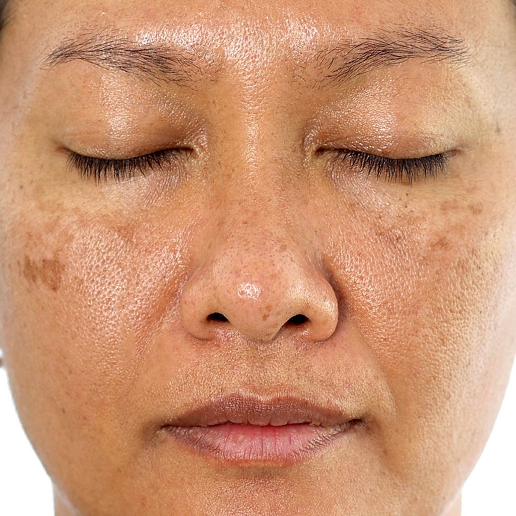 Face Pigmentation Face Pigmentation Singapore