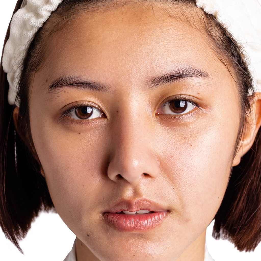Female face with uneven skin tone - Illumia Medical