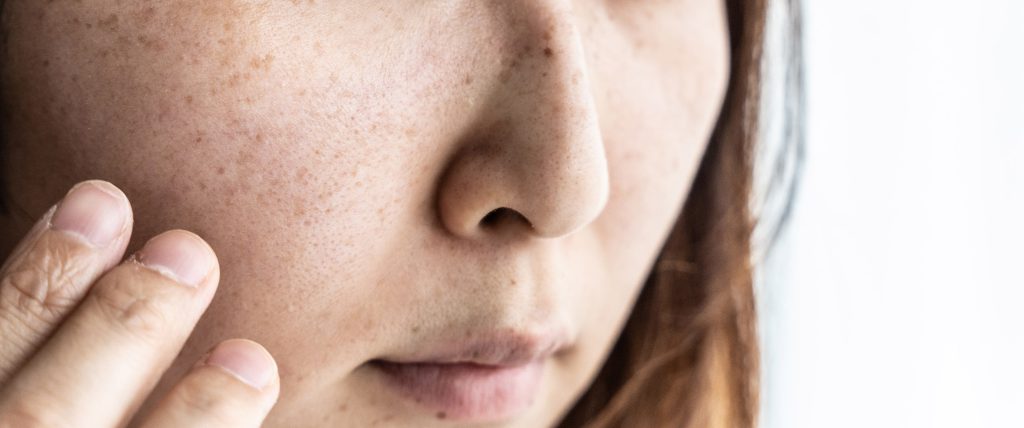 Pigmentation Pigmentation Singapore